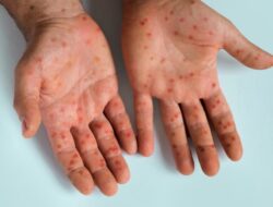 RSUD Taman Husada Bontang Imbau Warga Waspada Penyebaran Cacar Monyet